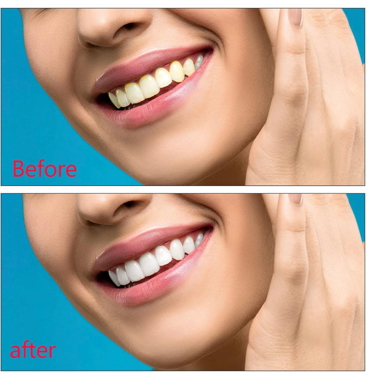 FOCA 2 MINUTES SNAP ON SMILE VENEERS, NO GLUE NEEDED , JUST SNAP ON, INTRAORAL SCAN IS DONE BY A DENTIST AND RESULT SENT TO US FOR ACCURATE TEETH SIZE